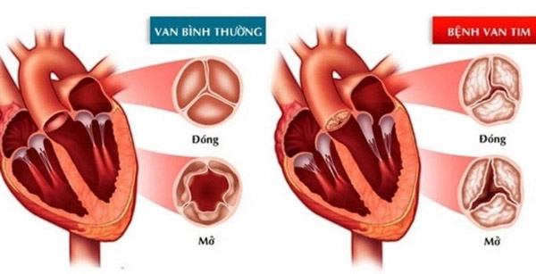 Hở van tim xảy ra khi van tim đóng không kín